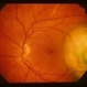 Choroidal Melanoma Choroidal Melanoma