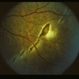 Choroidal Rupture After Trauma Choroidal Rupture After Trauma