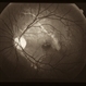Choroidal Rupture and a Trophy Post-trauma