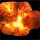 Choriodemia