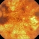 Choroideremia Choroideremia