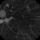 Choroideremia Choroideremia