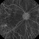 Choroideremia Choroideremia