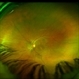 Chronic Central Serous Chorioretinopathy Chronic Central Serous Chorioretinopathy