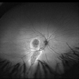 Chronic Central Serous Chorioretinopathy re af Chronic Central Serous Chorioretinopathy re af