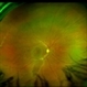 Chronic Central Serous Chorioretinopathy Re color Chronic Central Serous Chorioretinopathy Re color