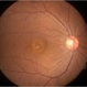Chronic Macular Hole Chronic Macular Hole