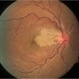 Cilioretinal Artery Occlusion Cilioretinal Artery Occlusion