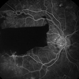 Preretinal Hemorrhage in Proliferative Diabetic Retinopathy