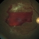 Preretinal Hemorrhage due to Proliferative Diabetic Retinopathy Preretinal Hemorrhage due to Proliferative Diabetic Retinopathy