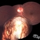Coloboma of the Retina and Choroid. Coloboma of the Retina and Choroid.