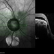 Coloboma of Disc & Choroid Coloboma of Disc & Choroid