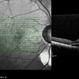 Coloboma of Disc & Choroid Coloboma of Disc & Choroid