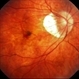 Myopic Choroidal Neovascular Membrane Myopic Choroidal Neovascular Membrane