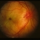 Commotio Retinae