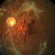 Regressed Proliferative Diabetic Retinopathy with Preretinal Hemorrhage Regressed Proliferative Diabetic Retinopathy with Preretinal Hemorrhage