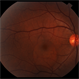 Central Serous Choroidopathy
