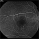 Central Serous Choroidopathy