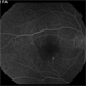 Central Serous Choroidopathy