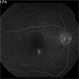 Central Serous Choroidopathy