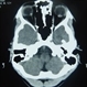 Orbital CT Scan in Optic Nerve Drusen Orbital CT Scan in Optic Nerve Drusen