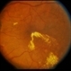 BDR / Macular Edema / Macroaneurysm BDR / Macular Edema / Macroaneurysm
