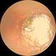 Wide Field Image of Fundus Coloboma Wide Field Image of Fundus Coloboma