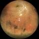Intermediate uveitis Intermediate uveitis