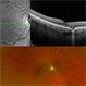 Idiopathic Choroidal Neovascularization
