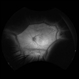 Idiopathic Uveal Effusion Syndrome Idiopathic Uveal Effusion Syndrome