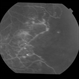 Adult Coats' Disease