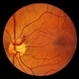 Preretinal Vascular Loop Preretinal Vascular Loop
