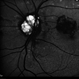 Optic Nerve Head Drusen