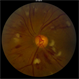 Radiation Retinopathy Radiation Retinopathy
