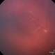 Diffuse Choroidal Hemangioma Diffuse Choroidal Hemangioma
