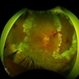 Retinal Detachment Following Scleral Buckling, Retinectomy, Laser, and Oil Retinal Detachment Following Scleral Buckling, Retinectomy, Laser, and Oil
