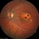 North Carolina Macular Dystrophy With CNV North Carolina Macular Dystrophy With CNV