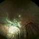 Choroidal Blow-Out