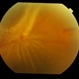 Retinal Fold Near Retinal Break in Rhegmatogenous Retinal Detachment