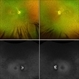 Retinitis pigmentosa with disc drusen Retinitis pigmentosa with disc drusen