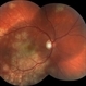 Acute Posterior Multifocal Placoid Pigment Epitheliopathy Acute Posterior Multifocal Placoid Pigment Epitheliopathy