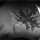 Serpiginous Choroidopathy  Autofluorescence