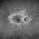 MIDD (Maternally Inherited Diabetes and Deafness) - Right FA (4 min)