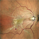 Epiretinal Membrane