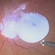 Intravitreal Triamcinolone Acetonide Intravitreal Triamcinolone Acetonide