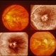 Myopia Myopia