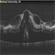Garland of Superficial Infarct on OCT