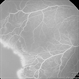 Retinopathy of Prematurity Stage 2 Retinopathy of Prematurity Stage 2