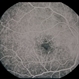 Ring 17 Chromosome Ring 17 Chromosome