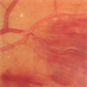 Vein Occlusion Zoom in a BRVO Vein Occlusion Zoom in a BRVO